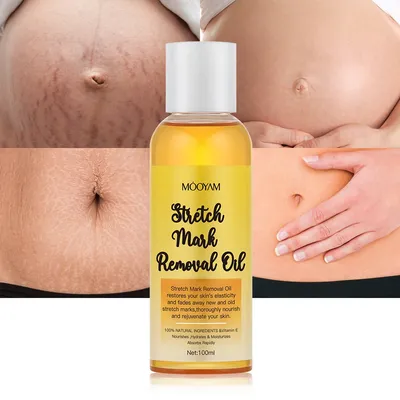 Stretch Mark Removal Oil for Removing Dark Spot on Postpartum Abdominal Skin