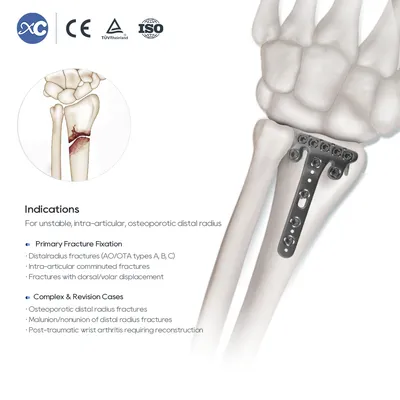 Clinical Orthopedic Volar Radius Multi-Axial Plate Implant for Bone Surgery
