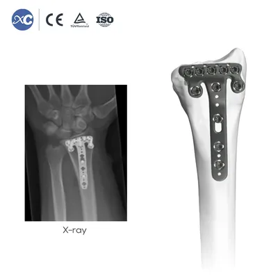 Specialized Orthopedic Distal Radius Bone Plate with Volar Radial Tap