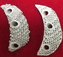 Non-Bearing Hydroxyapatite (HA) Implanted Artificial Bone